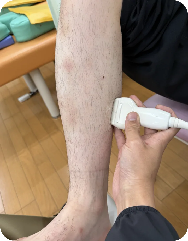 ふくらはぎの肉離れをエコーで観察している様子