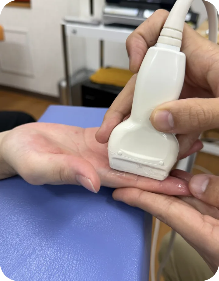突き指をエコーで観察している様子